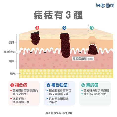 胸部長痣|痣變大、痣多或長毛會變皮膚癌？認識痣的形成與原因